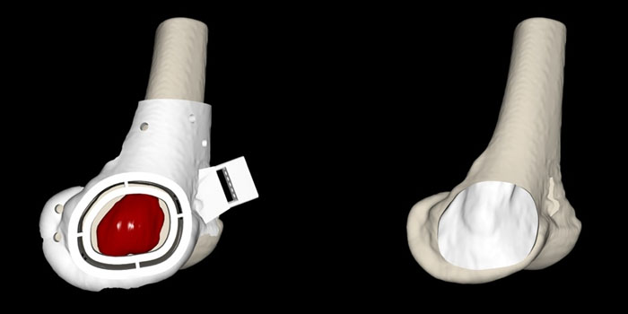 Bodycad新服务实现定制化3D打印骨科植入物