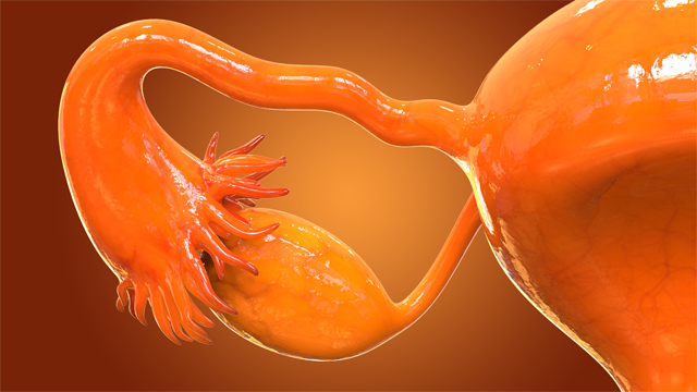 卵巢癌晚期研发管线分析：哪家能挑战一线疗法？
