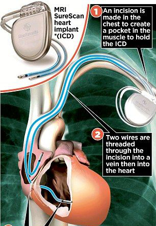 新式心脏植入设备可以让患者在植入后能进行MRI扫描