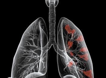 默克辉瑞联手开发肺癌药物组合