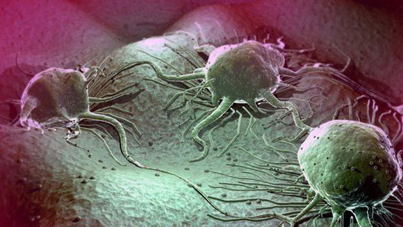 寻找癌细胞的照妖镜 黄金纳米粒子癌症检测法