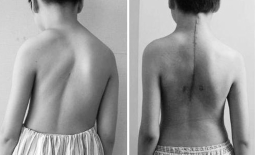 复旦大学发现导致先天性脊柱侧凸新机理