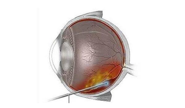 胚胎干细胞首次培养出立体视网膜