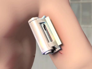 日本研发出可在体内溶解的止血夹