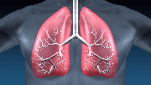 美西北大学医学院揭示肺移植感染致命原因