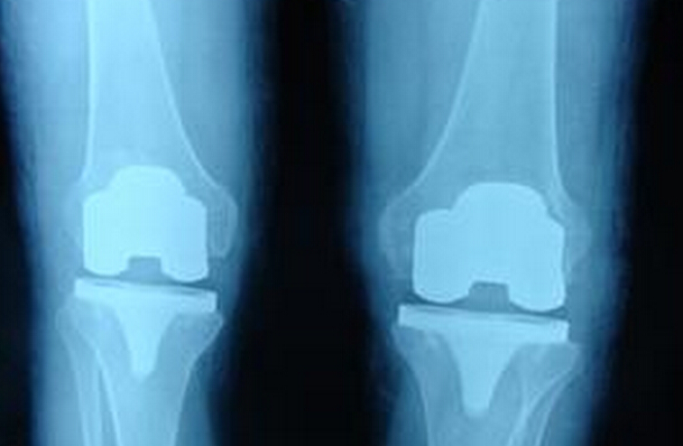 新技术或将促发人造膝关节植入物革命
