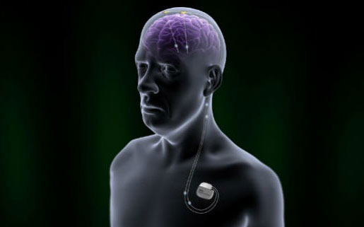 FDA审批通过一种可用于改善帕金森病症的脑部植入设备brio neurostimulation system