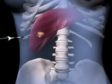 ScientificReports：胰腺癌细胞会因射频治疗表型改变