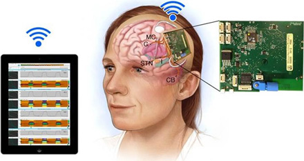 远程遥控大脑不是梦，新型植入装置来实现