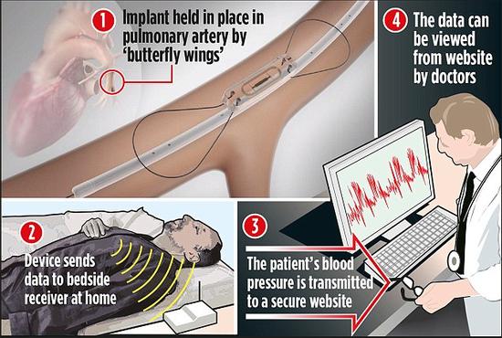硬币大小的可植入预警系统可监测心力衰竭