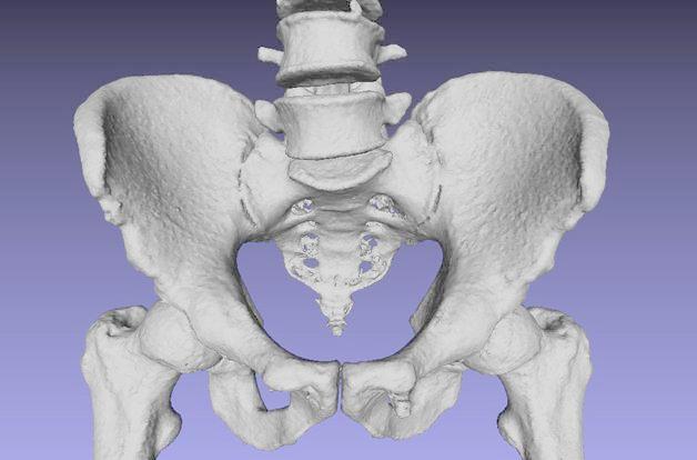 韩国首例3D打印定制骨盆助豆蔻少女成功更换，重新下地走路