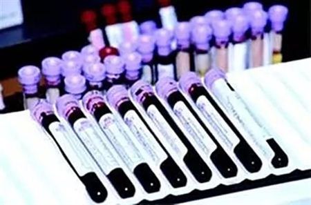 新技术：血液miRNAs检测可以识别胰腺癌癌前病变 