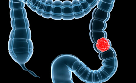 结直肠癌的精准化疗法及基因组进化蓝图