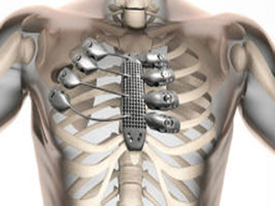 首例3D打印钛合金胸肋骨植入手术成功