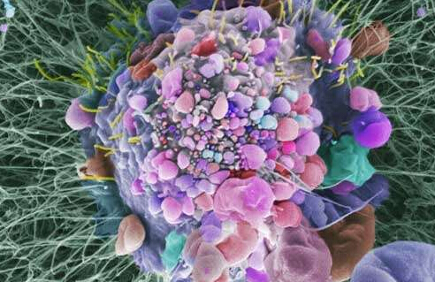 JCO：新型免疫疗法药物治疗恶性黑色素瘤