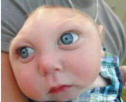 贾克森，强，美国半脑婴儿过了一岁生日