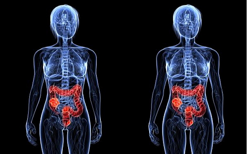 Nature medicine：结肠直肠癌有四种类型