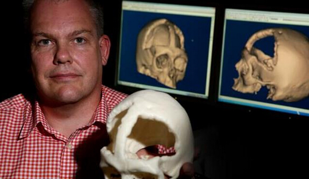 澳洲医院研究使用3D打印干细胞技术使患者头骨重生