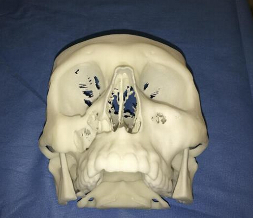 3D打印助力医生完成突破性的无疤痕面部重建