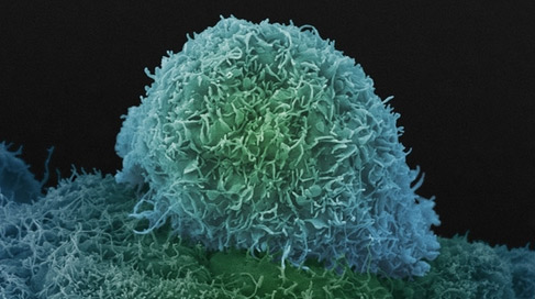 自杀式基因治疗：让前列腺癌细胞“自杀”！