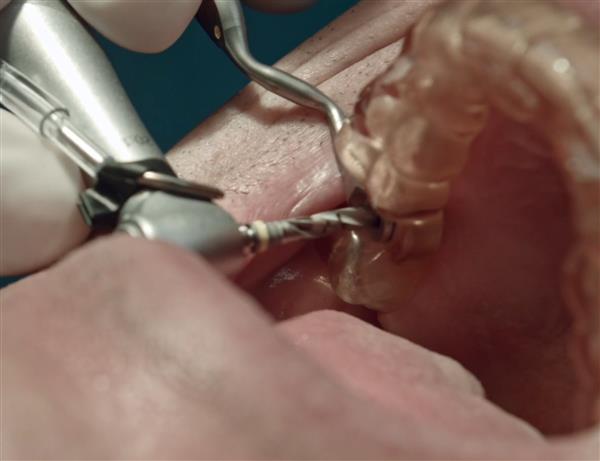 第一颗3D打印的MFH材料的牙冠植入人体 受用者是开发人自己