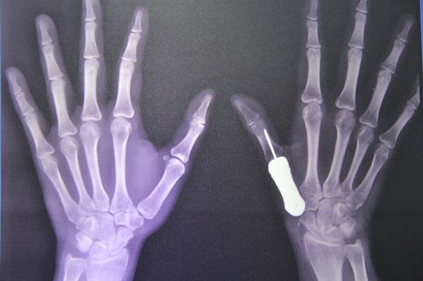 泰国医生完成世界首例3D打印钛金属拇指骨移植