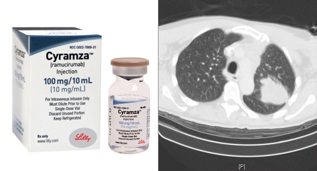 欧盟批准礼来肿瘤药物Cyramza（ramucirumab）两种新适应症