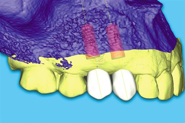 美牙科研究人员利用虚拟模型和3D打印优化牙齿植入术