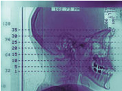 美国医生用金属支架和皮肤制造出新的食道