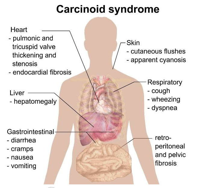 类癌综合症新药carcinoid syndrome获FDA优先审评资格