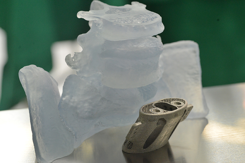 世界首例高位骶骨整块切除并3D打印假体重建术在清华长庚医院骨科成功完成