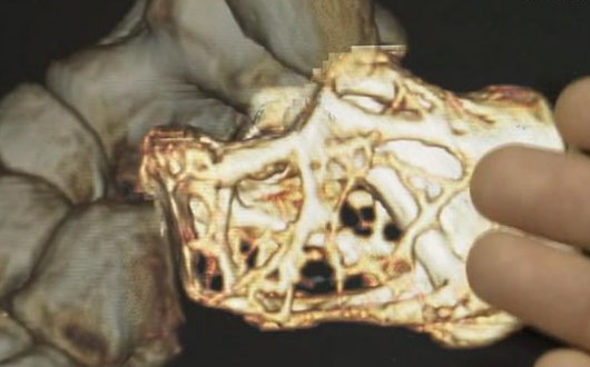 韩国医生首次完成3D打印足跟骨植入手术