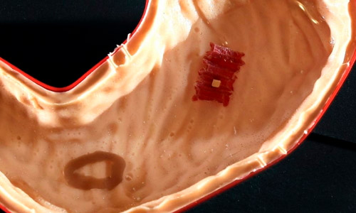 胃不舒服？吃了这款“迷你机器人”就好啦！