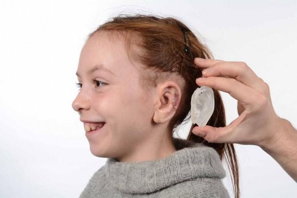 3D扫描及打印让小耳症患者重获自然耳朵