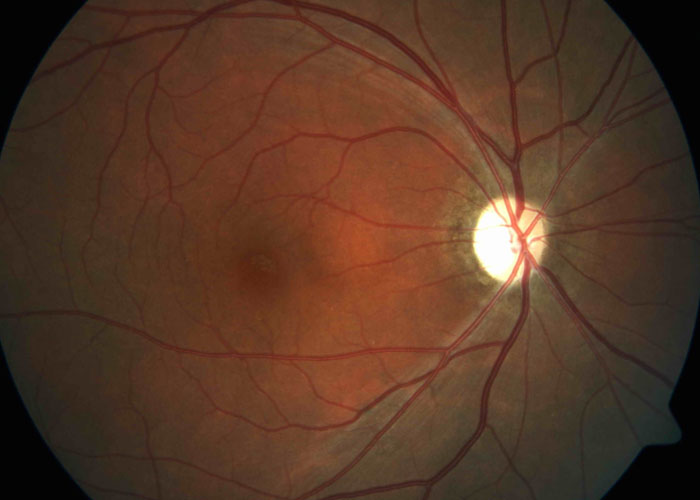 科学家首次成功修复小鼠受损视神经
