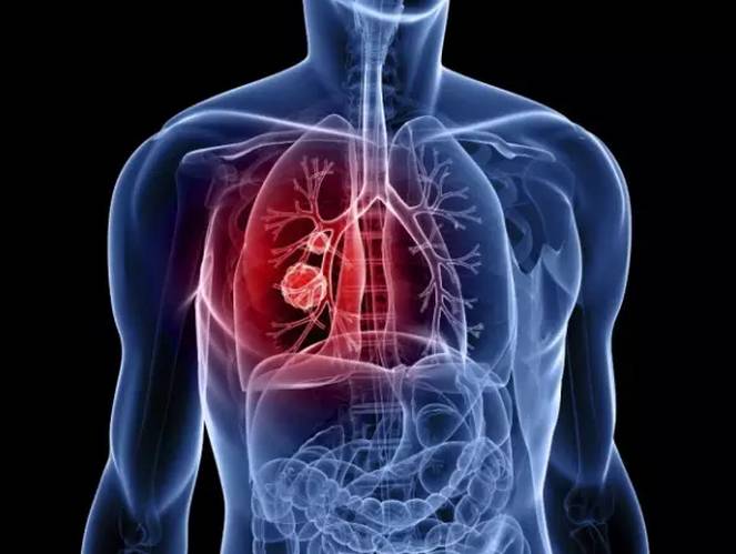 中国原创药艾维替尼临床疗效初显，突破肺癌靶向治疗难题