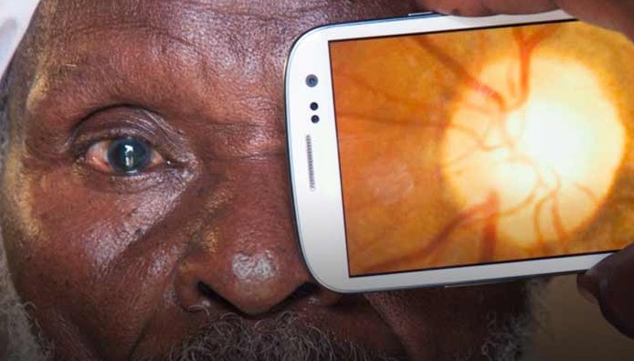 英国剑桥咨询公司推出智能手机检测青光眼的廉价方案Viewi
