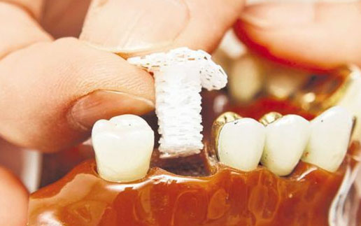 科学家3D生物打印支架可助骨骼生长为牙科植入物