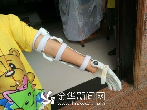 金华企业推出假肢3D打印，征集手部有缺陷的孩子