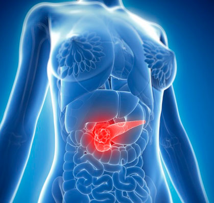 科学家发现外泌体与胰腺癌之间的神秘关系