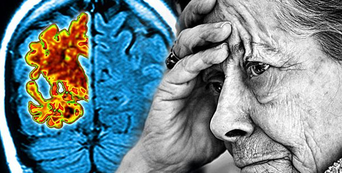 阿尔茨海默症：我们在通往新药的正确路上吗？