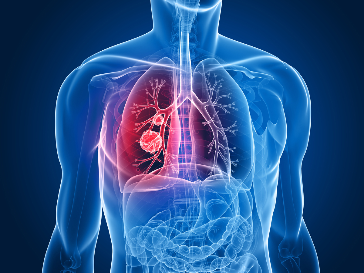 第17届世界肺癌大会亮点一览