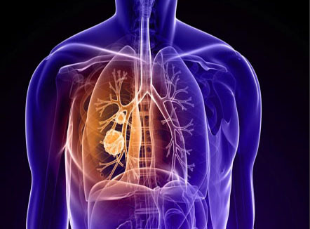 最全肺癌靶向和免疫治疗药物解析