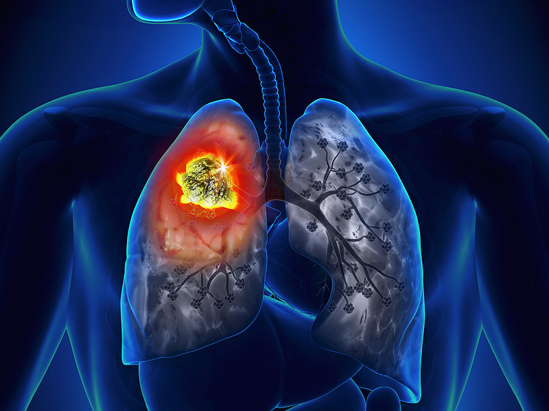 盘点：未来5年10大抗肺癌药物