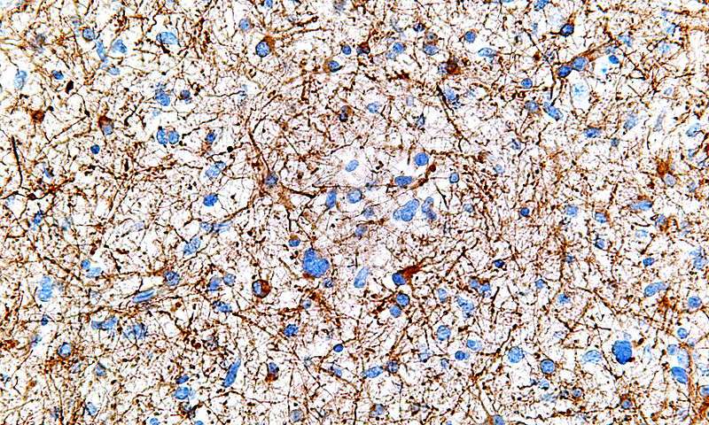科学家找到控制脑瘤生长的关键基因ZEB1