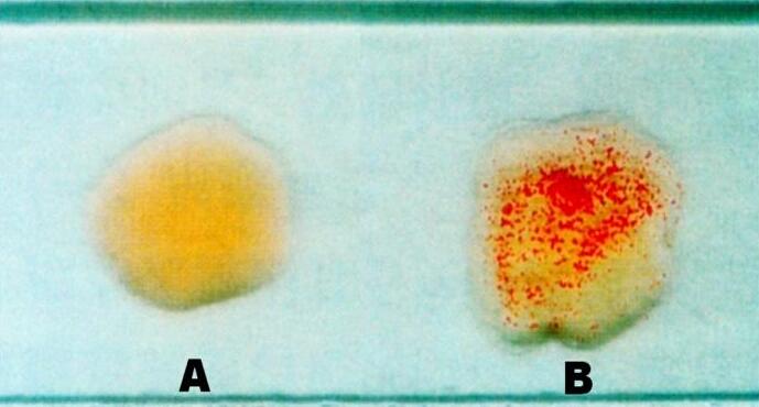女子患罕见病冷凝集素综合征，抽出血还未及化验就凝固