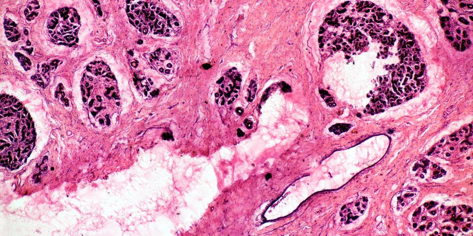 重磅：浙大科学家发现已获批糖尿病药物或可以治疗致命性乳腺癌