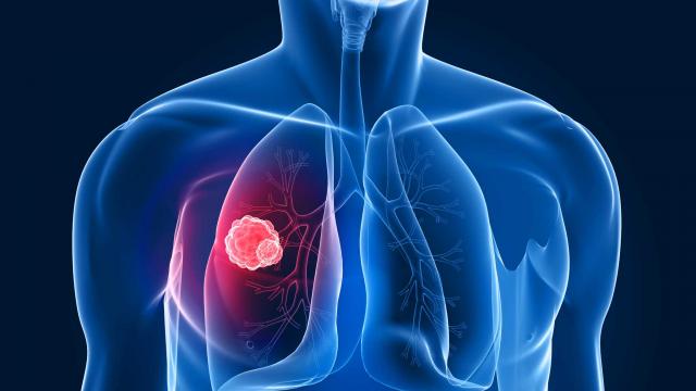 Nat Commun：一种肺癌亚型或能转化成为另一种亚型