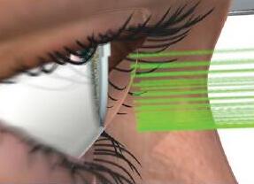 睿盟希国际眼视光基金投资以色列青光眼激光治疗器械公司BELKIN Laser 