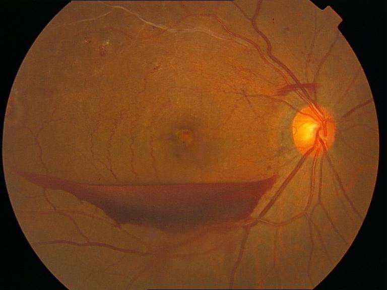 IBM糖尿病性视网膜病变研究新进展，检测与分类准确性达86%